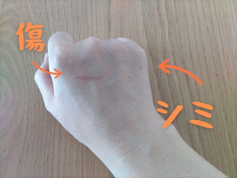 傷とシミがある手の甲